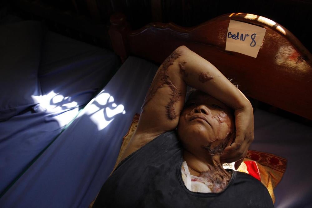 Keo Srey Vy, victime d’une attaque à l’acide, se repose après une opération de greffe de peau au Centre cambodgien de survivants d’attaques à l’acide (Cambodian Acid Survivors Charity, CASC) à Phnom Penh, le 19 juillet 2010, au Cambodge. Ce centre a dû ce