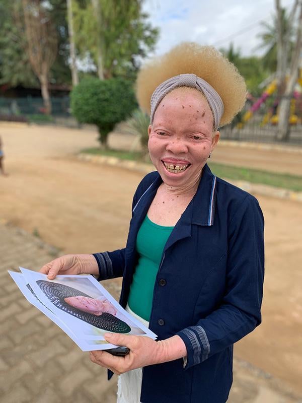 201906Africa_Mozambique_AlbinismCesaria