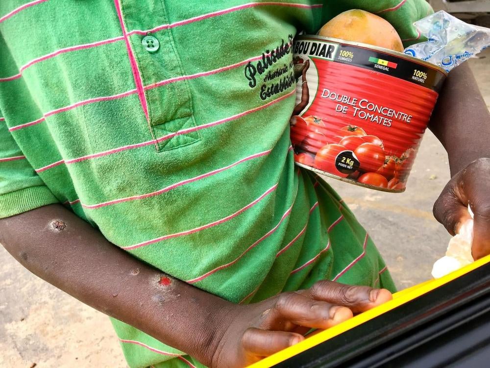 Un talibé de dix ans qui mendiait de l’argent à Dakar, au Sénégal, avait l’air gravement malade et ses bras présentaient des plaies à vif. 19 juin 2018. 