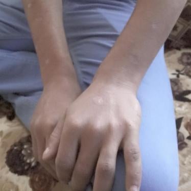 Cigarette burns cover the hands and arms of 18-year-old “Karim.” Kurdish authorities held him for 13 months.  He then returned home and was rearrested by authorities under Baghdad’s control, who tortured and held him for months. © 2018 San Saravan